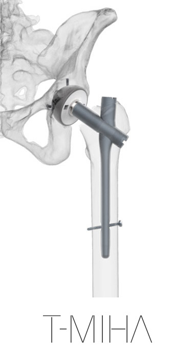 TOTAL HIP MIA SYSTEM